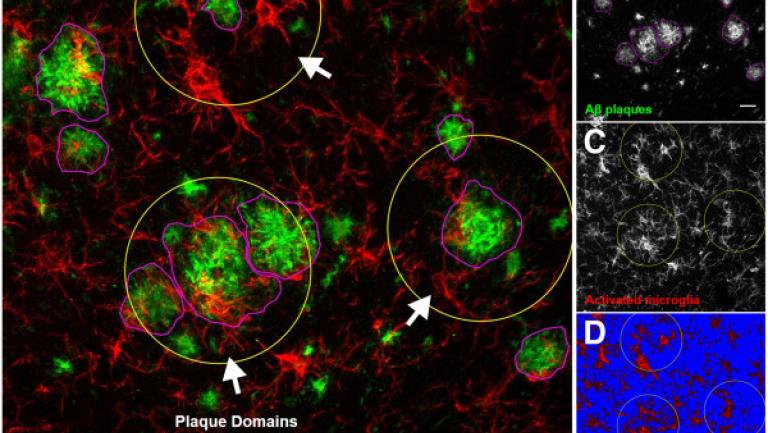 image for article on Research On Parkinson's Disease